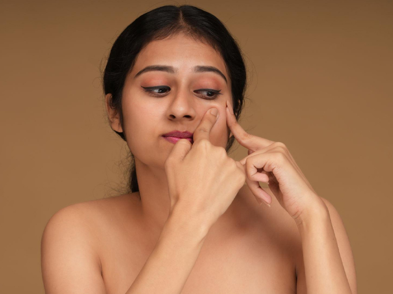 Best Acne Treatment in Ashok Nagar Chennai